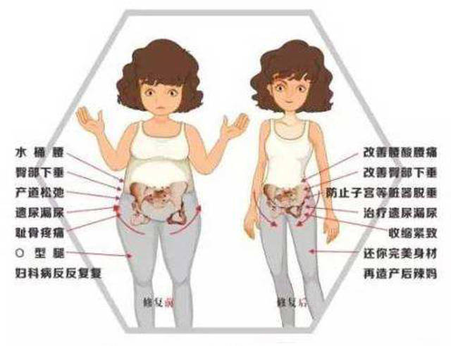 女性盆底肌修复的最佳时期是什么时候