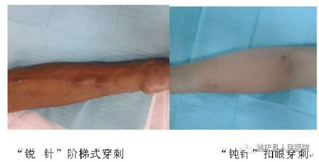 【新技术】鹤庆县人民医院血透室开展血透穿刺新技术——钝针扣眼穿刺