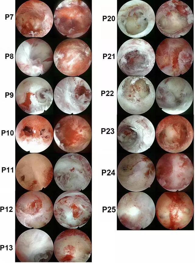精心!宫腔粘连为什么跳绳能改善"为期不远"-第2张图片-卡慢网
