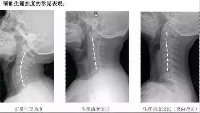 人體頸椎的生理彎曲正常狀態是前凸的,但並非一成不變.