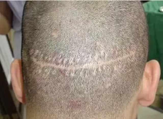 「发际线」の拯救行动——fut,fue植发术