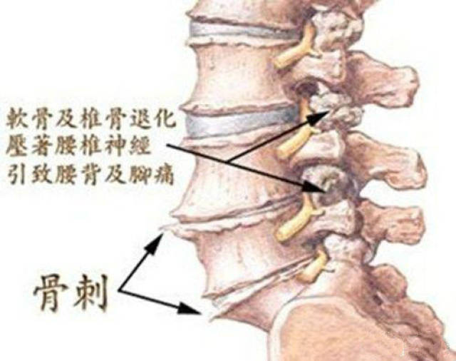 骨刺长在哪里图片图片