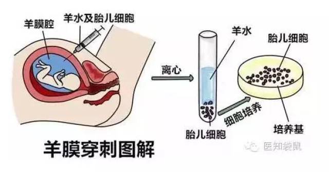 羊水穿刺示意图图片