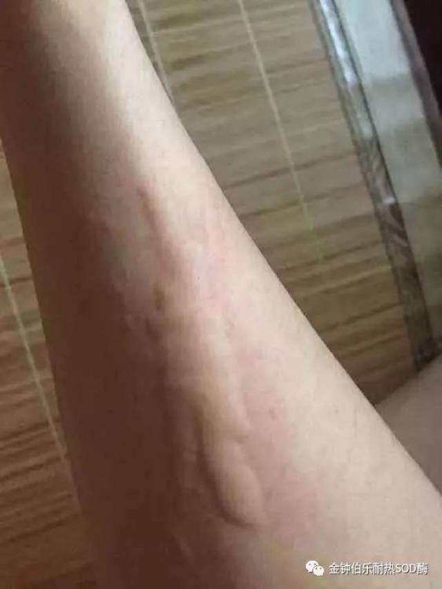 有一种痒,叫"荨麻疹痒"