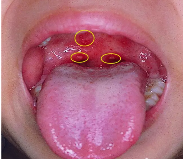 儿童咽峡炎症状图片