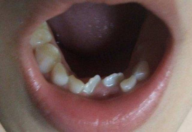 七岁小孩牙齿黑不换牙怎么办?