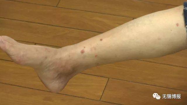 【健康】夏季到了,一定要将它"赶尽杀绝"!不然苦不堪言