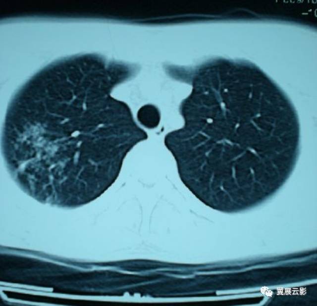 成人肺结核与肺癌的ct特征性表现及影像鉴别