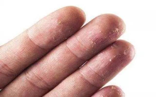 汗疱症又称为出汗不良性湿疹,为一种手掌,足跖部的水疱性疾病,多见于