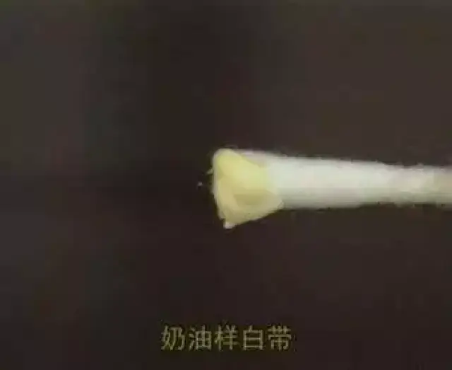 分泌物像豆腐渣图图片