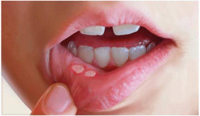 咽腭弓疱疹图片