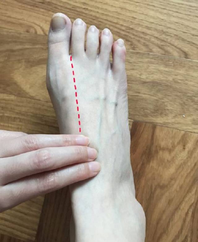 血肿,血栓……介入穿刺后的这些并发症,是可能避免的!