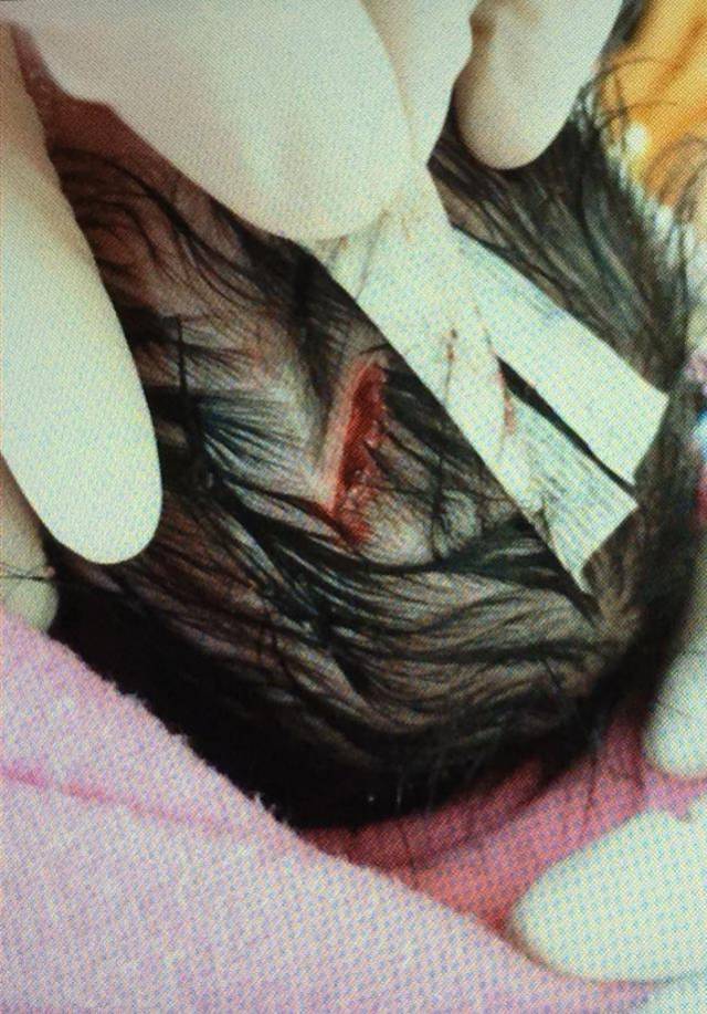 吓人香港医院剖腹产手术伤及婴儿头顶切开2厘米伤口