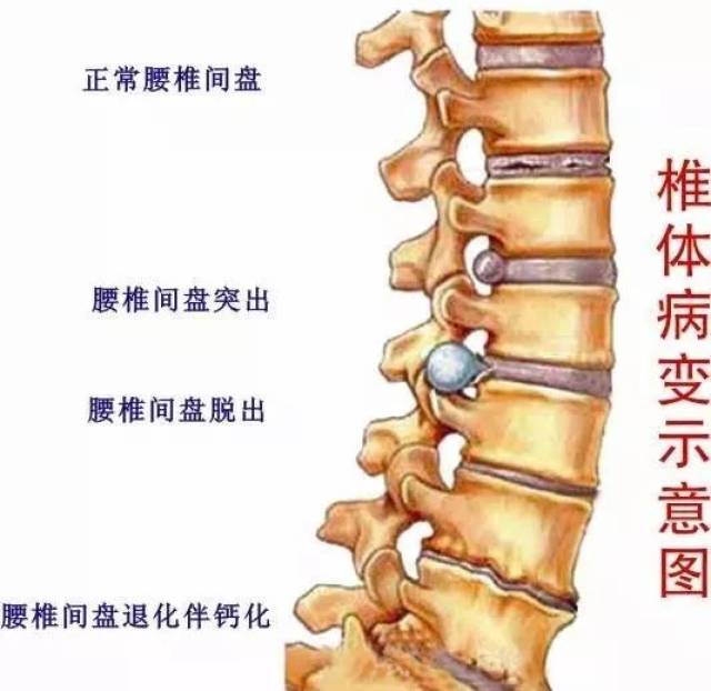 注意,不要把腰痛都推给腰椎间盘突出!