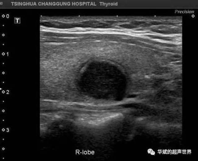 如何把甲状腺低回声结节变成高回声结节?