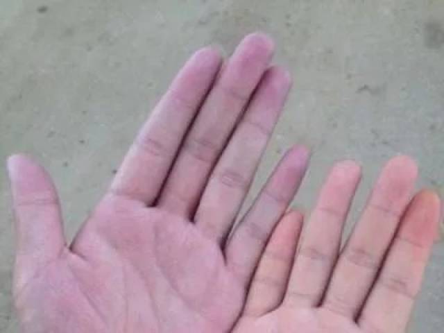 孕妈手指出现这3种症状,说明已经严重贫血了!_手机搜狐网