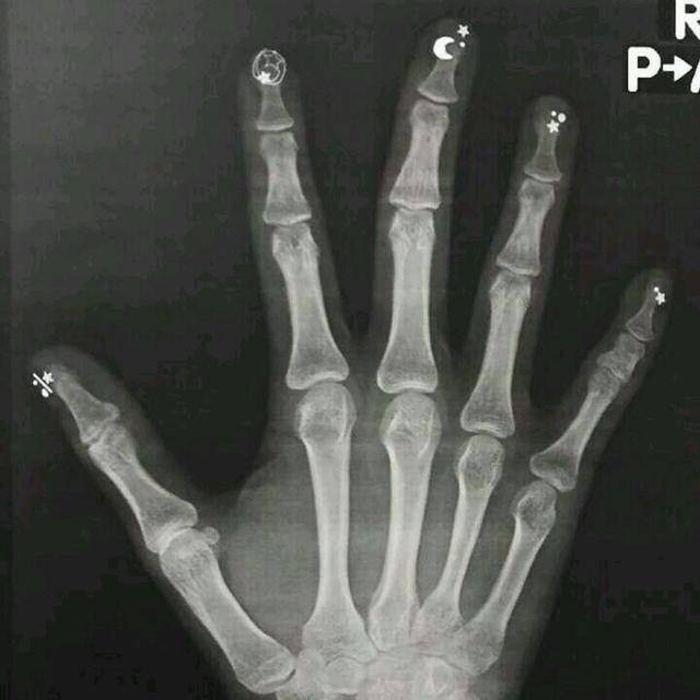 绝地求生:吃鸡女玩家一激动把手弄伤,去医院拍出了文艺ct片_手机搜狐