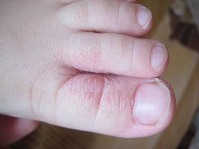 父母经常带小孩到洗浴中心3岁可爱男童染上脚气