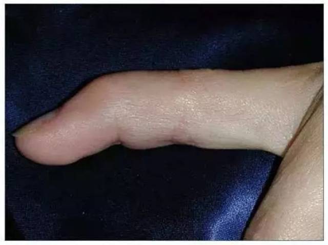 顾而取名为"槌状指",也有说"锤状指",是同一个意思