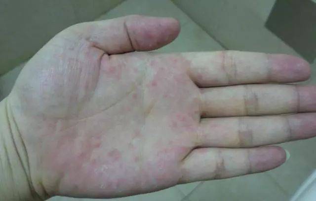 palm)指患慢性肝炎特别是肝硬变后,在手掌大拇指和小指的根部的大小