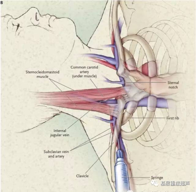 超声引导下锁骨下静脉穿刺