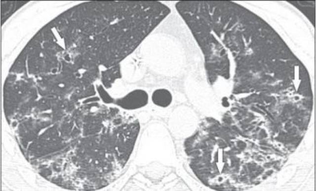 参考文献:kanne j p, yandow d r, meyer c a.