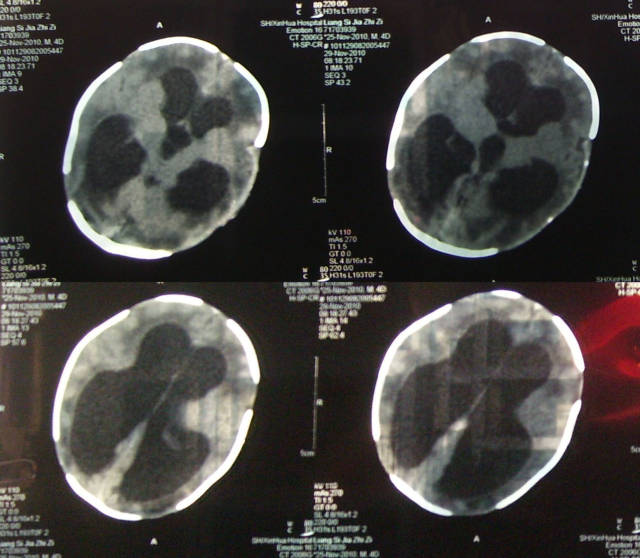 这是一个脑积水患儿的片子
