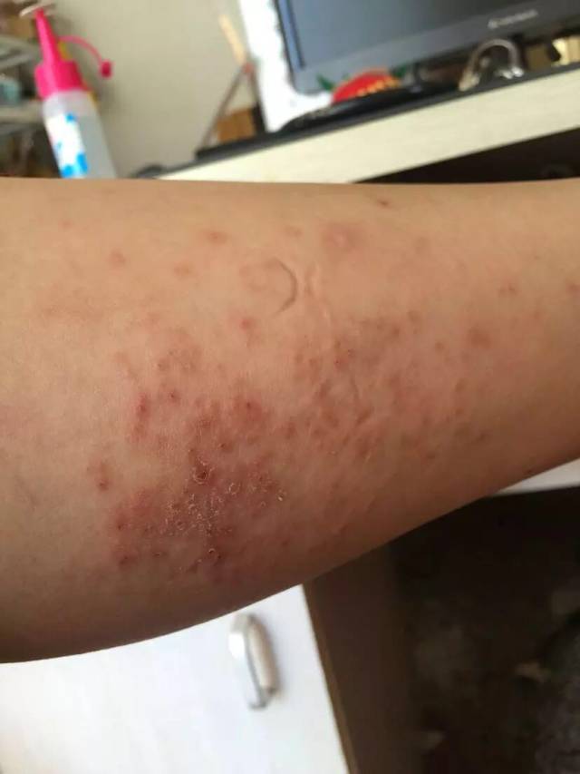 孕妇湿疹奇痒难耐又不能吃药,其实你只需注意这几点