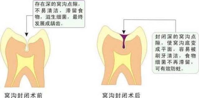 根管治疗过程详解