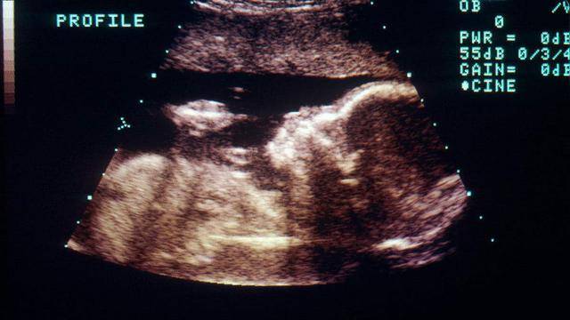 葡萄胎胎儿图片