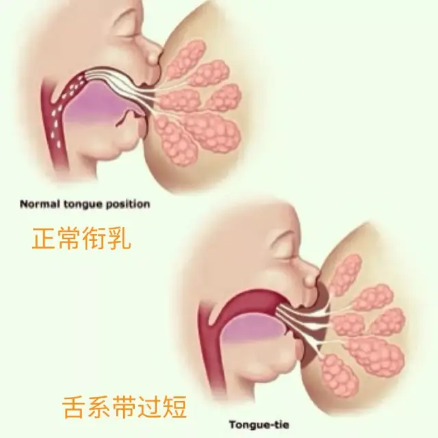 如果宝宝舌头长这样,妈妈要注意了!