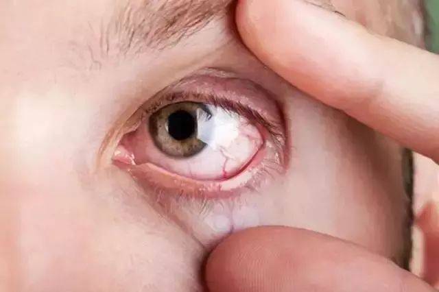 眼结膜上布满了毛细血管,一旦血管破裂,就会有充血现象