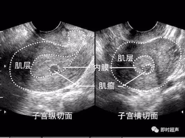 粘膜下肌瘤超声图片图片