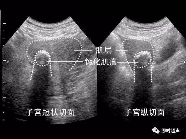 肌壁间子宫肌瘤10x10mm图片