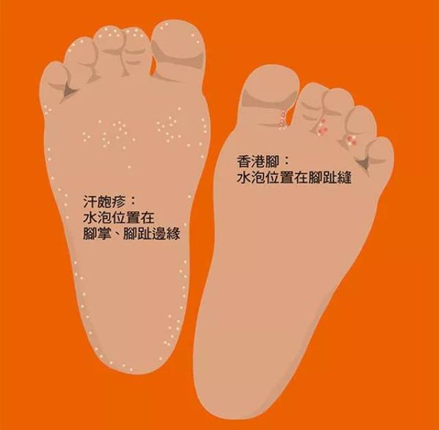 汗疱疹vs香港脚傻傻分不清?