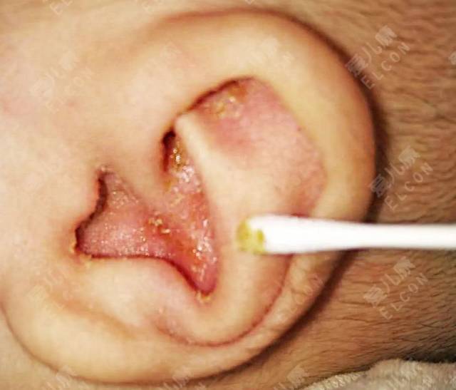 (照片由爱儿康家长提供)问题一宝宝2个月,最近发现宝宝两个耳朵流黄水