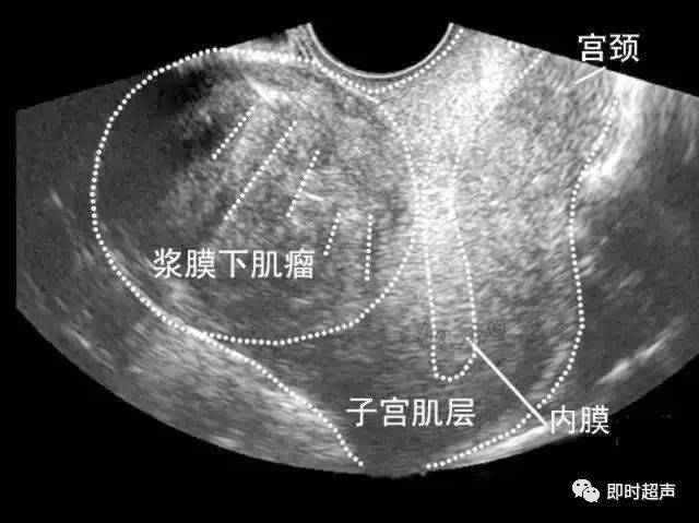 子宫肌瘤变性超声图片图片