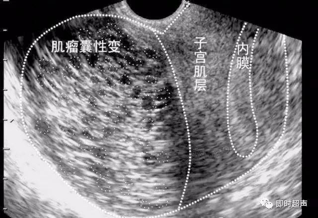 子宫肌瘤超声分类诊断