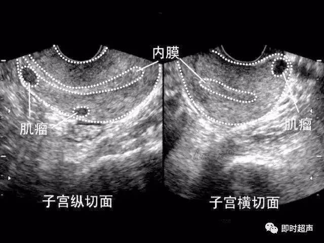 子宫肌瘤变性超声图片图片