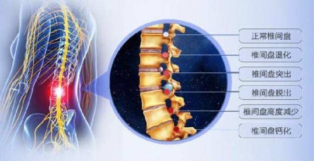 腰间盘突出疼痛难忍三则中医食疗方缓解疼痛