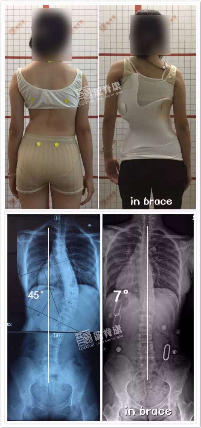 脊椎侧弯 对比图片
