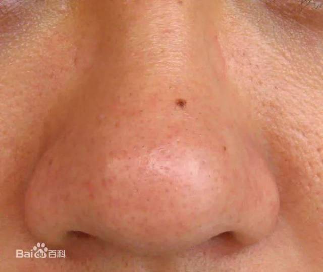 祛除黑头攻略,请拿好!