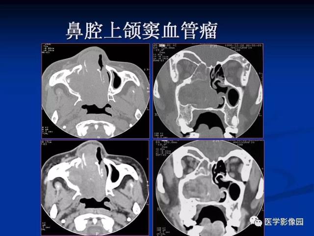 鼻腔,鼻竇良,惡性腫瘤的ctmr診斷(一) | 影像天地