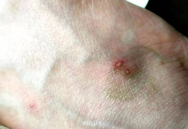 近日,有一位厦门的小伙伴 在环岛路椰风寨公交车站等车时 被蚂蚁叮咬