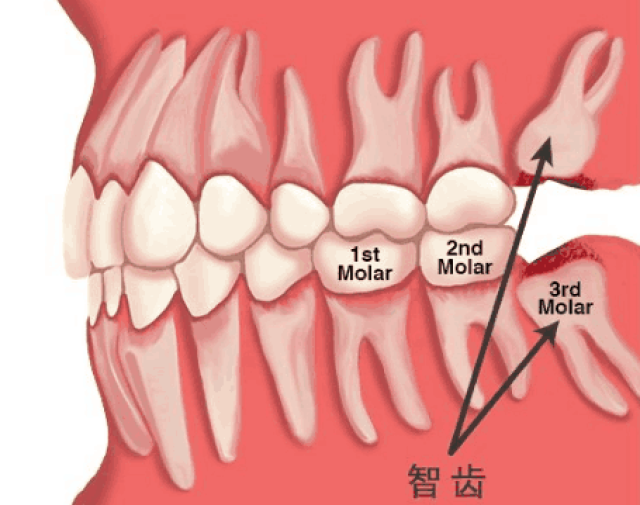 智齒本是第三大臼齒(又稱第三磨牙),現在我們有餐具幫助切碎食物,飯食