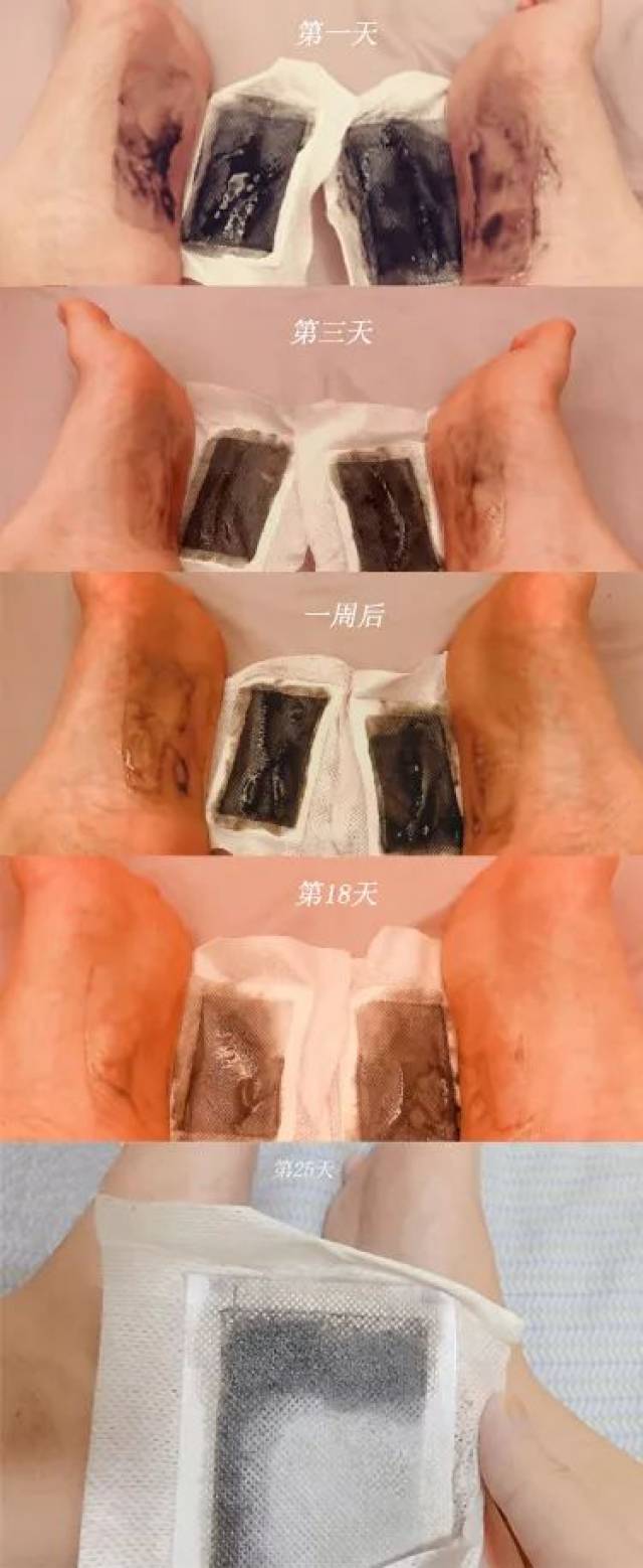 泰国人又变态了!用它祛湿,1贴顶上10碗薏仁汤!泰国人都是这么做的!