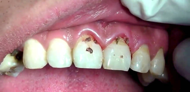 更可怕的"龈下牙结石",你造吗?看完还不洗牙_手机搜狐网