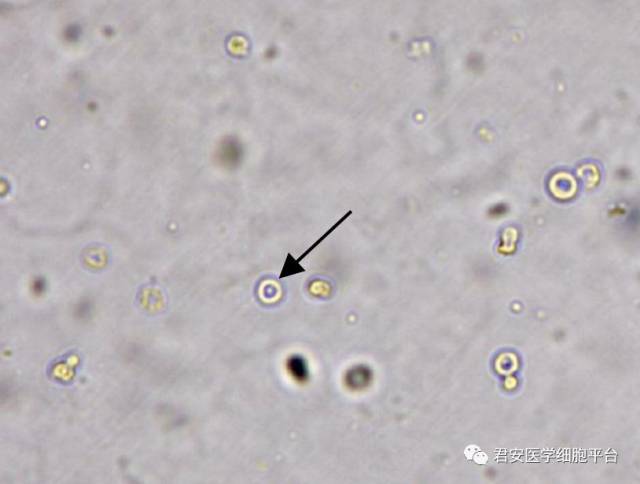 尿液棘形红细胞图片图片