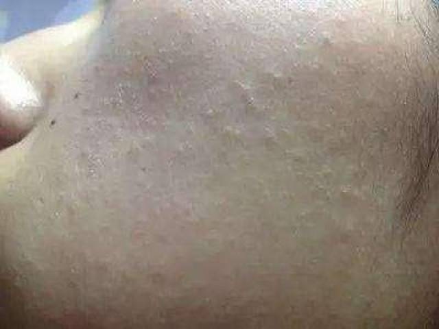 激素脸的逆光疹,很多人不了解