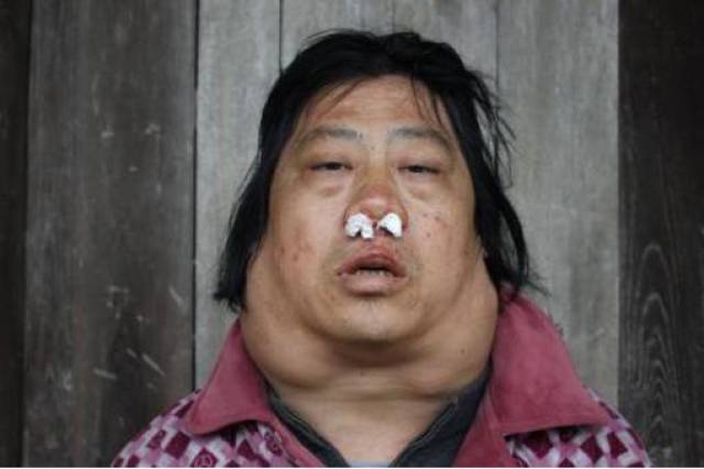 2,清晨回缩性血涕:鼻咽癌患者在平时吐痰时可发现其中带有血丝,尤其